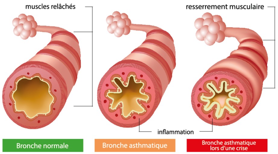Bronche obstruée lors d'une crise asthme allergique : alchimie interieure à Tours 37 vous propose des soins énergétiques pour déprogrammer les allergies respiratoires