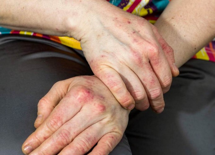 maladies de peau, eczéma, psoriasis, acné, lucite, urticaire. La méthode JMV pour deprogrammer les allergies qui pourraient créer ces inflammations de la peau à Tours 37